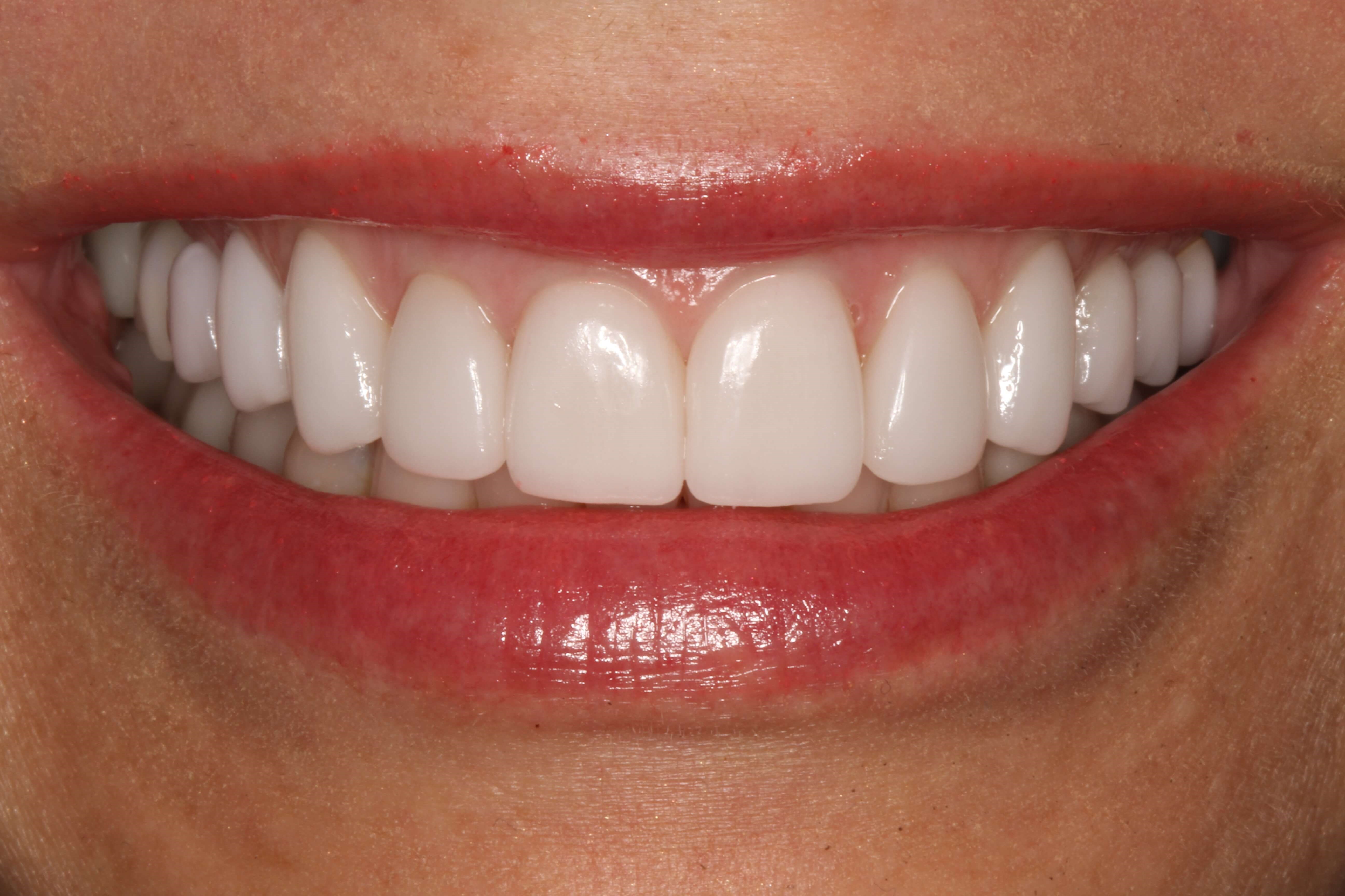 Smile Makeover B & A After