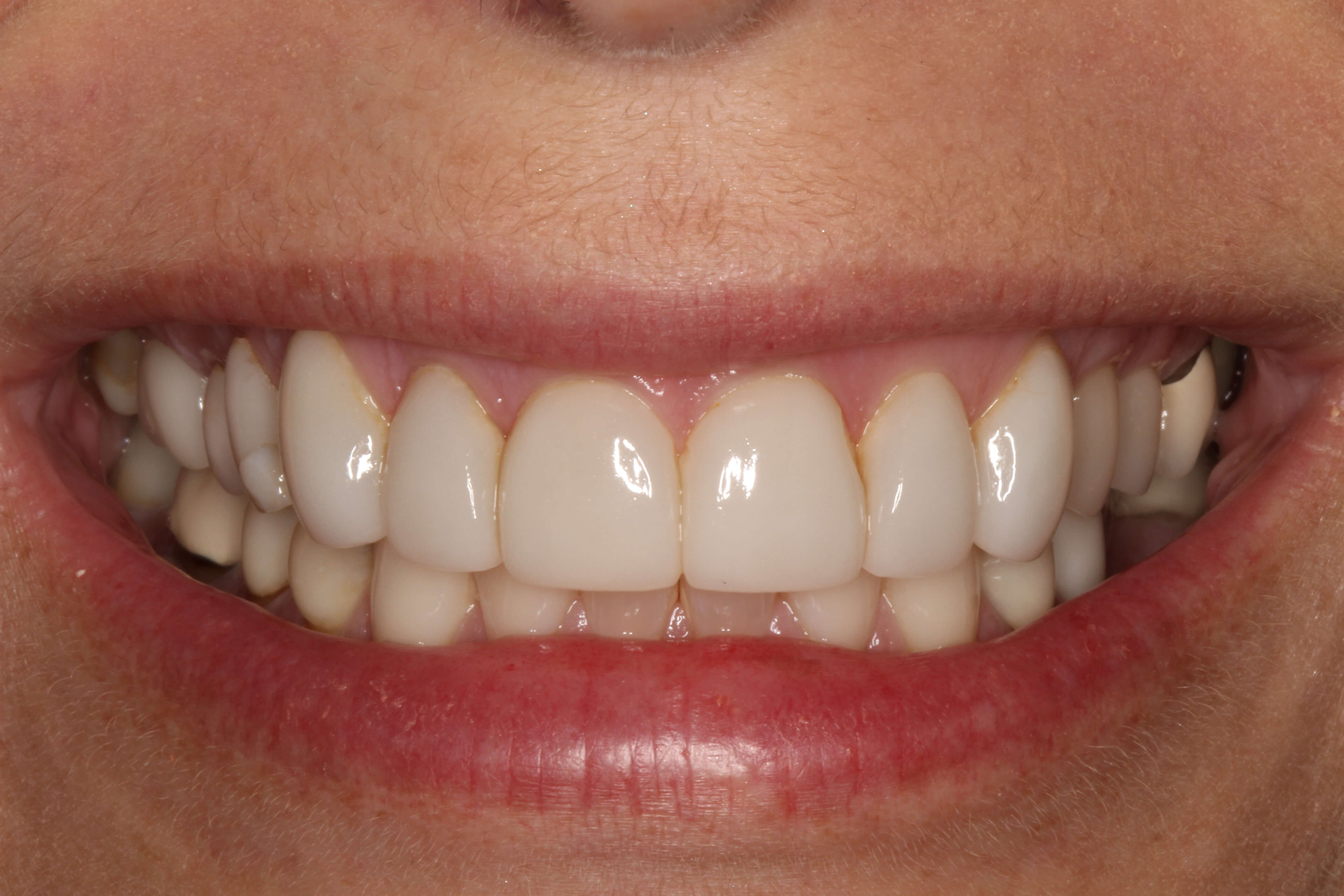 Smile Makeover B & A Before