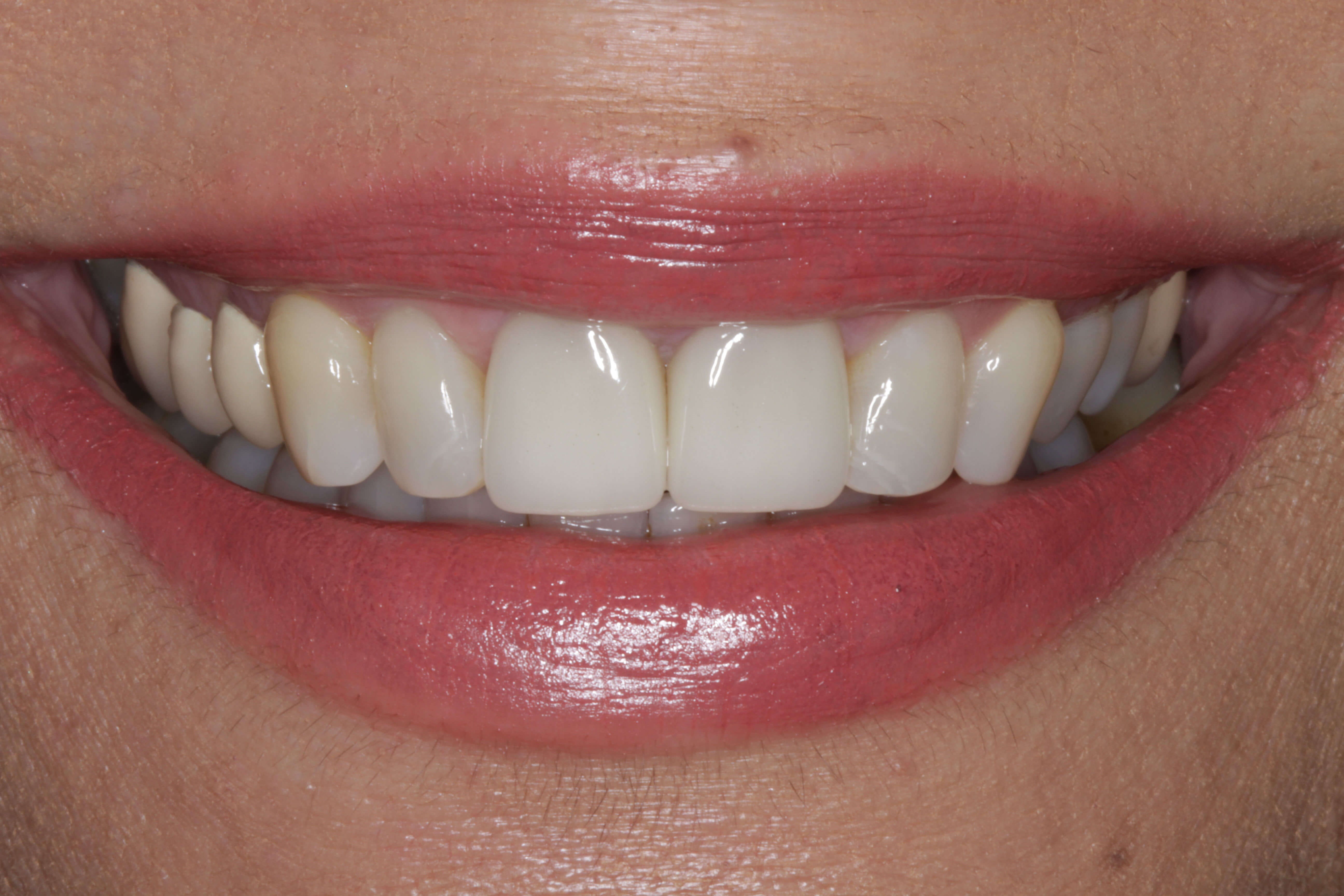 Smile Makeover before & after After