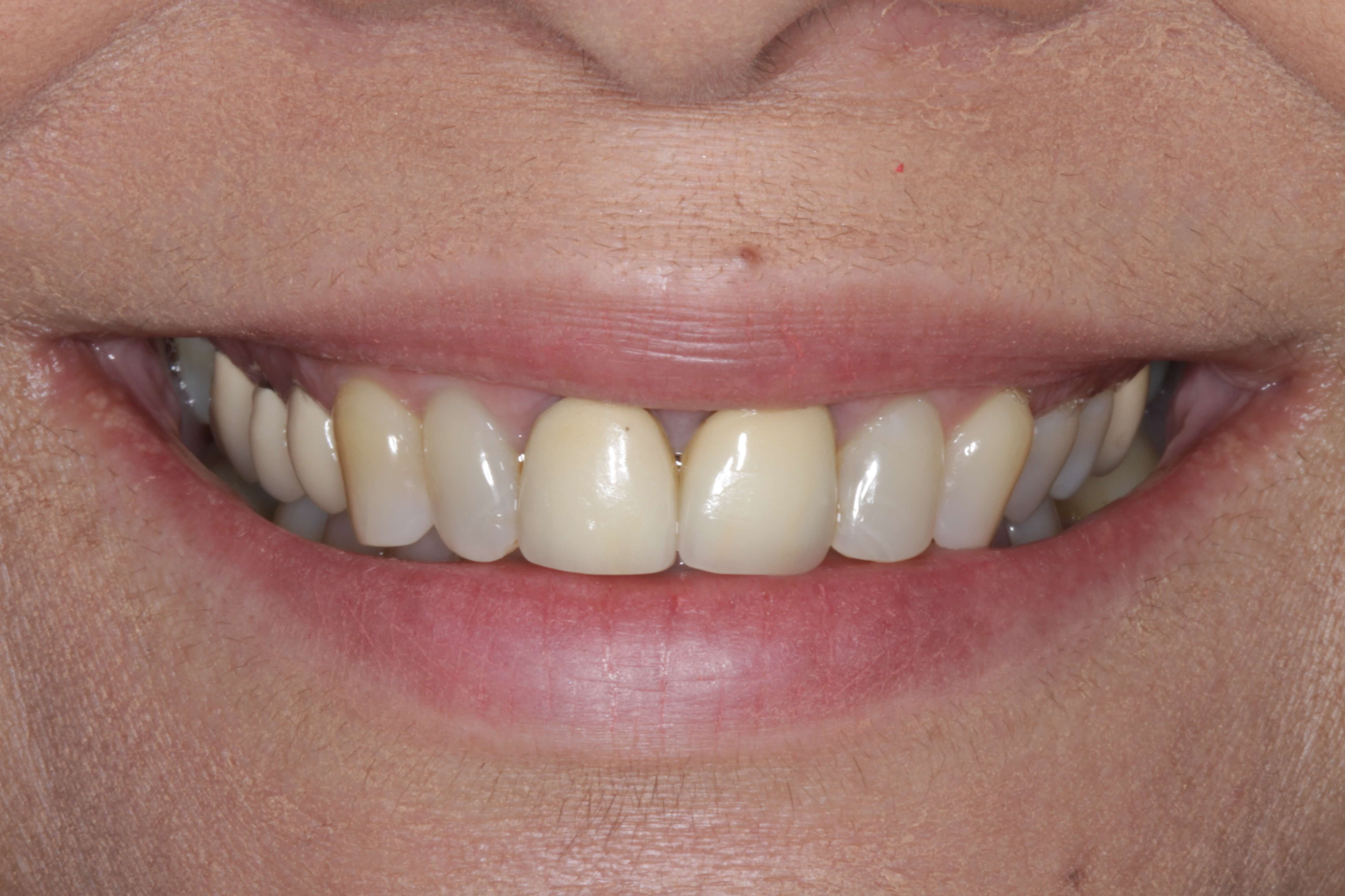 Smile Makeover before & after Before